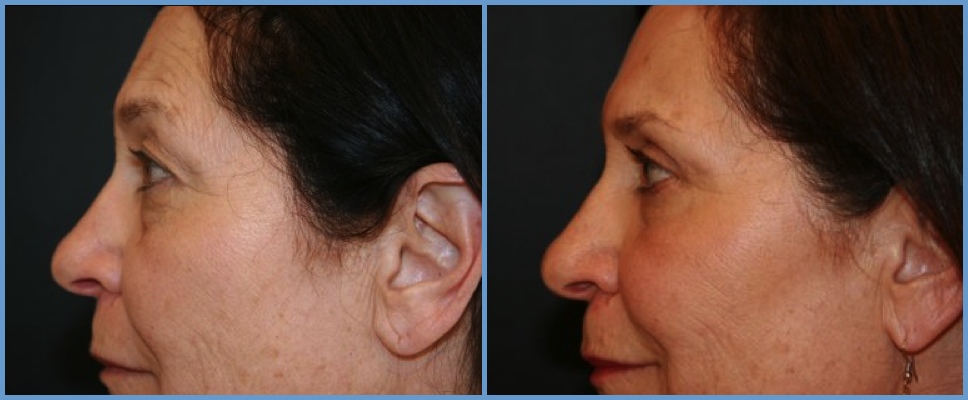 Eyelid Surgery - Blepharoplasty