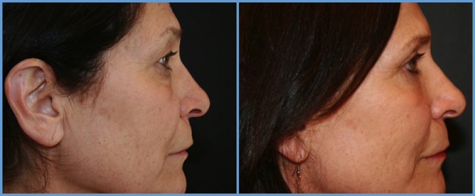 Eyelid Surgery - Blepharoplasty