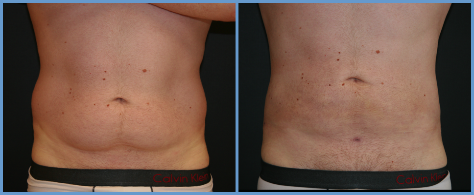Abdominal Wall Liposuction Sculpture Male