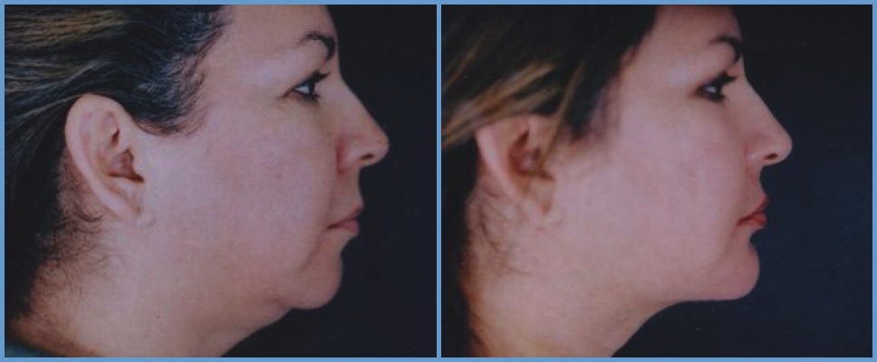 Chin Agumentation