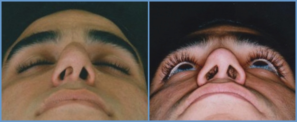 Nose Surgery - Rhinoplasty Men