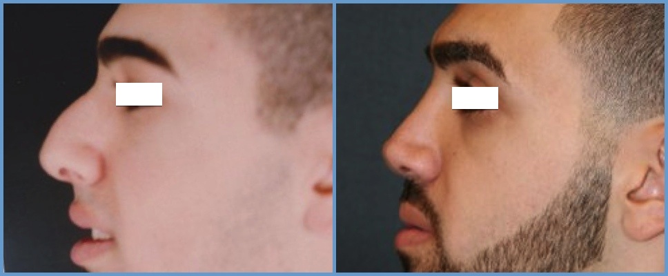 Nose Surgery - Rhinoplasty Men