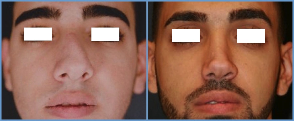 Nose Surgery - Rhinoplasty Men