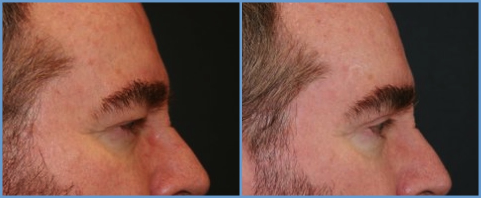 Eyelid Surgery - Blepharoplasty