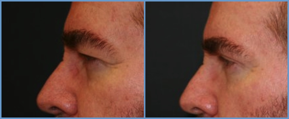 Eyelid Surgery - Blepharoplasty