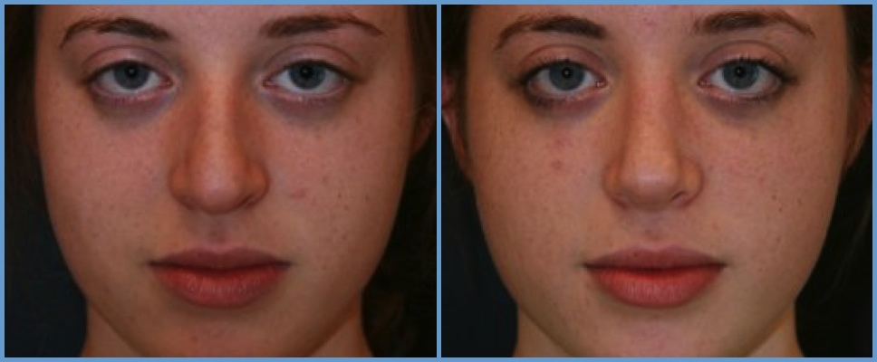 Nose Surgery - Rhinoplasty Women