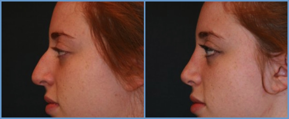 Nose Surgery - Rhinoplasty Women