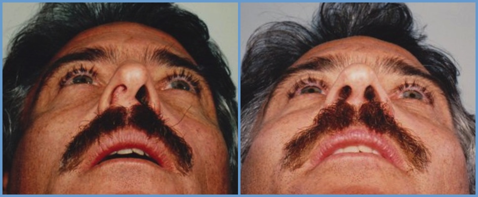 Nose Surgery - Rhinoplasty Men