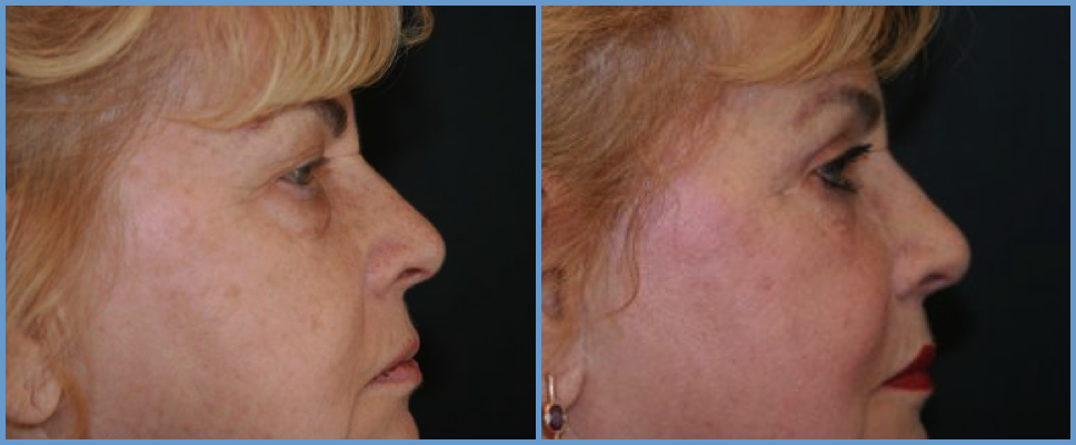Eyelid Surgery - Blepharoplasty