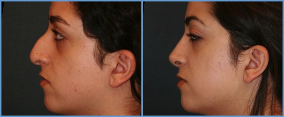 Nose Surgery - Rhinoplasty Women