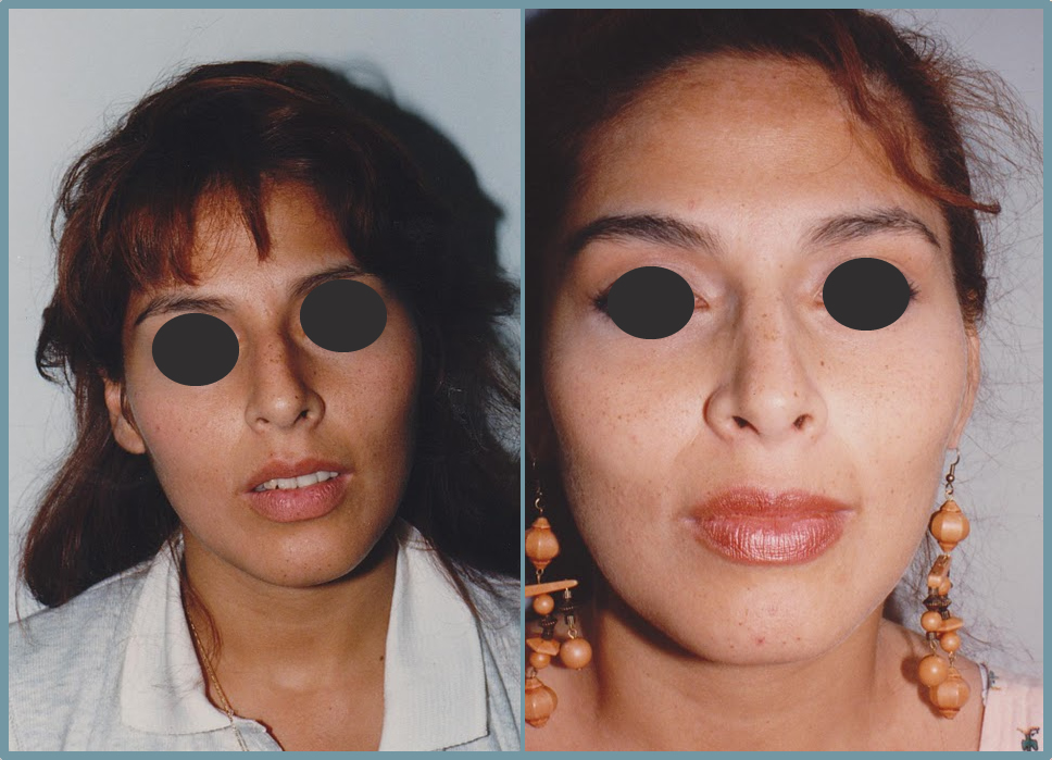 Nose Surgery - Rhinoplasty Women