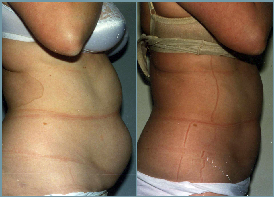 Abdominal Wall Liposuction Sculpture Female