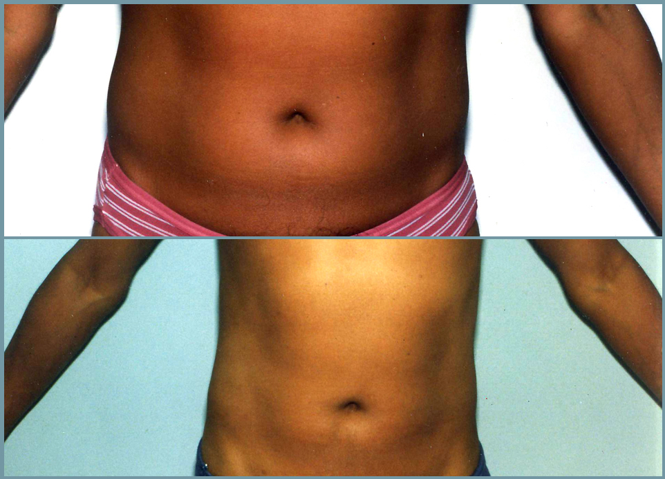 Abdominal Wall Liposuction Sculpture Male