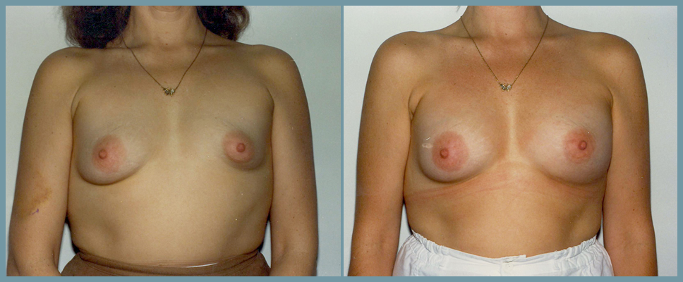 Congenital Breast Deformity