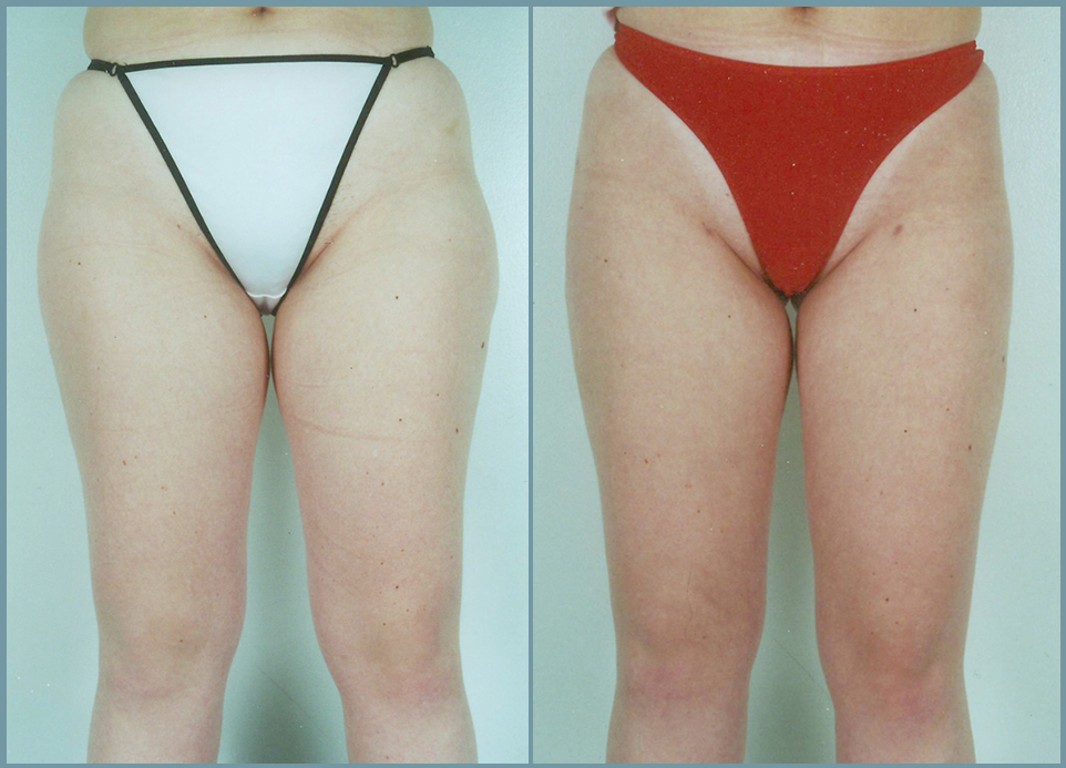 Liposculpturing of Hips