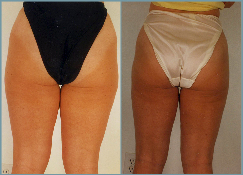 Liposculpturing of Hips