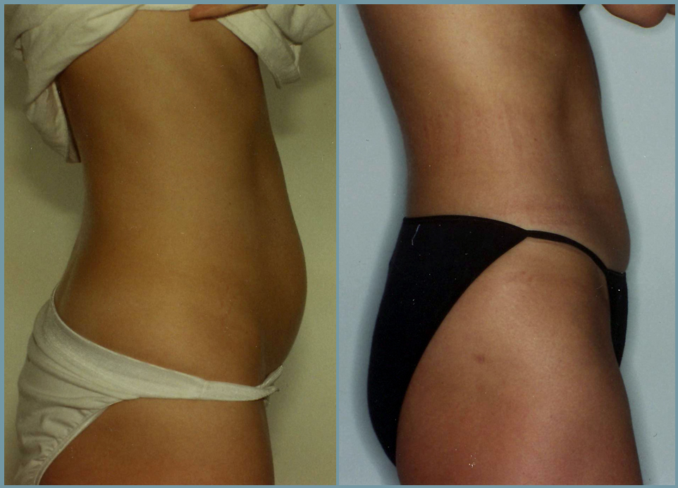 Liposculpturing