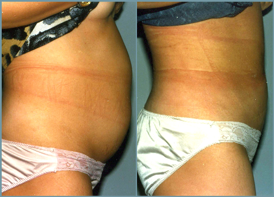 Liposculpturing