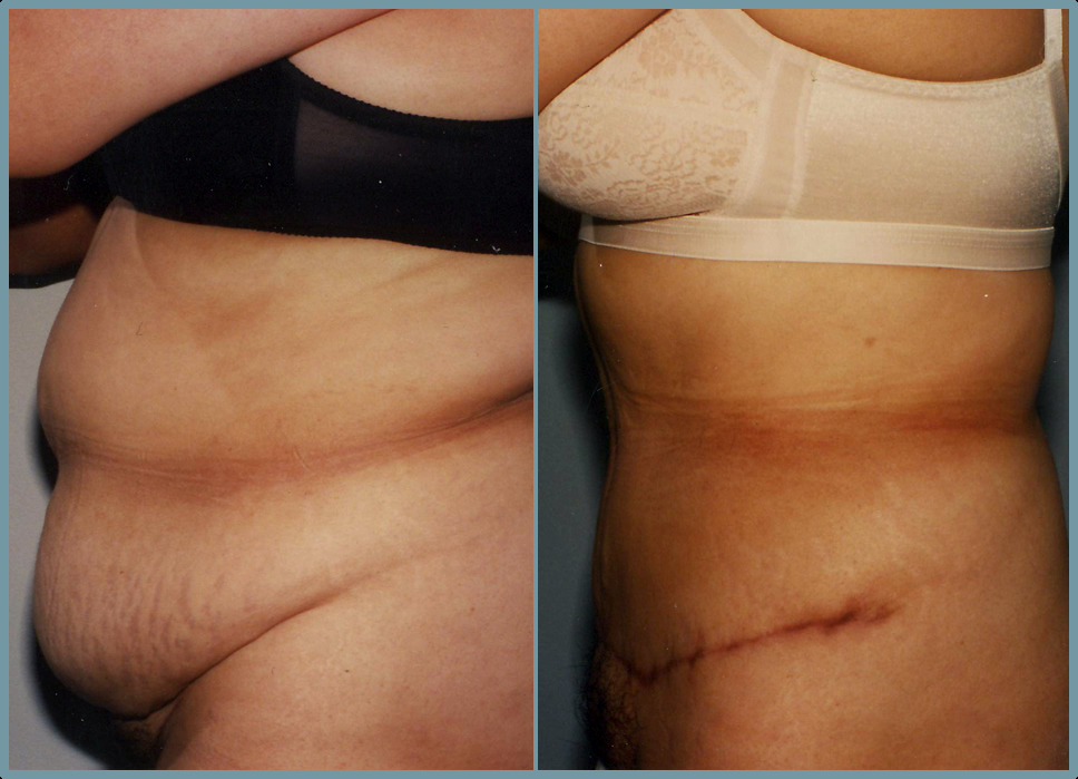 Abdomen - Abdominoplasty