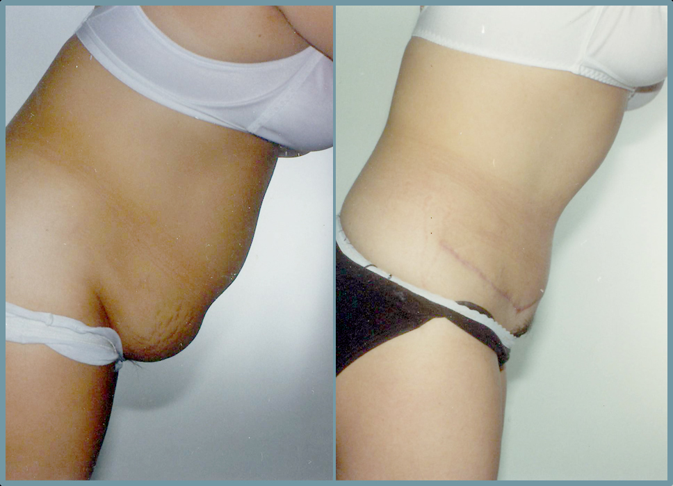 Abdomen - Abdominoplasty