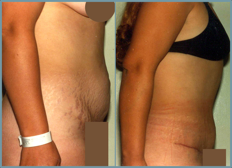 Abdomen - Abdominoplasty