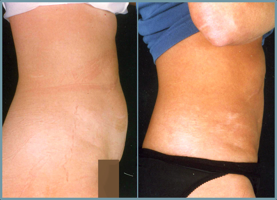Abdominal Wall Reconstruction