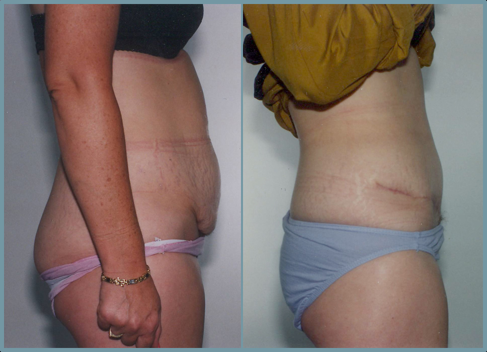 Abdomen - Abdominoplasty