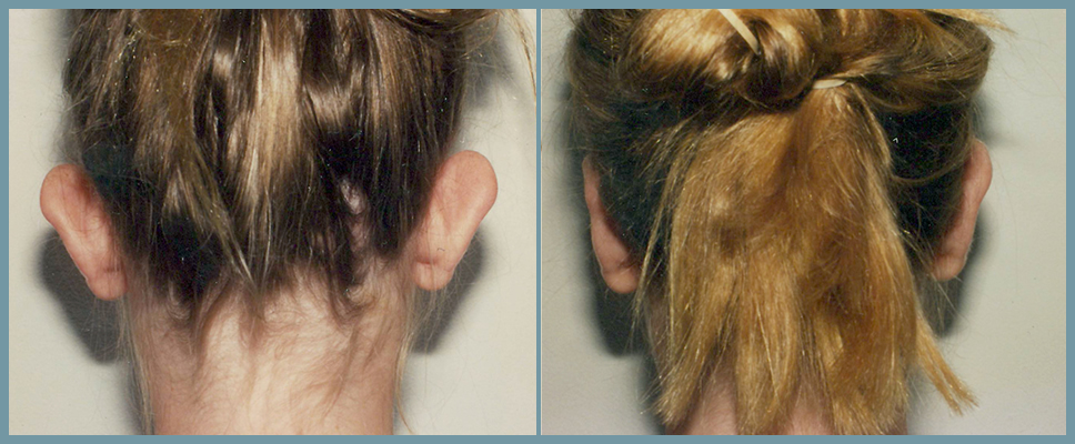 Otoplasty