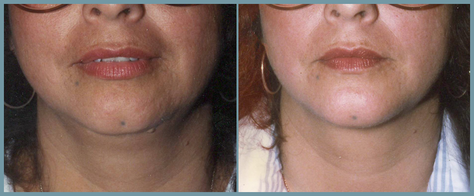 Chin Agumentation