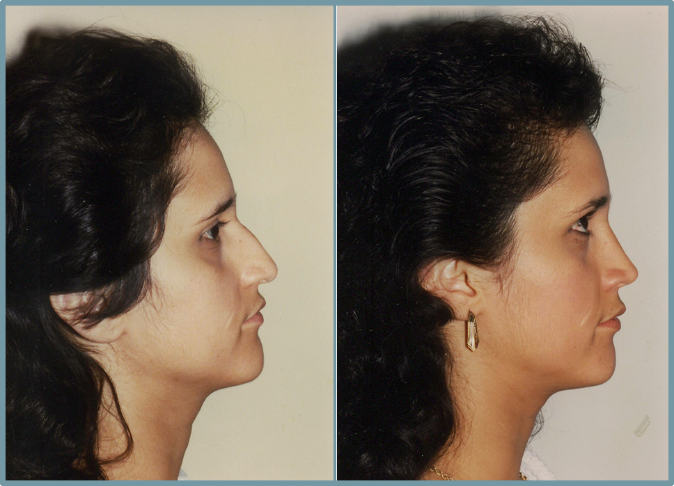 Nose Surgery - Rhinoplasty Women