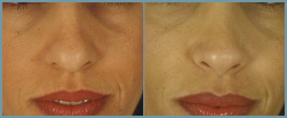 Nose Surgery - Rhinoplasty Women