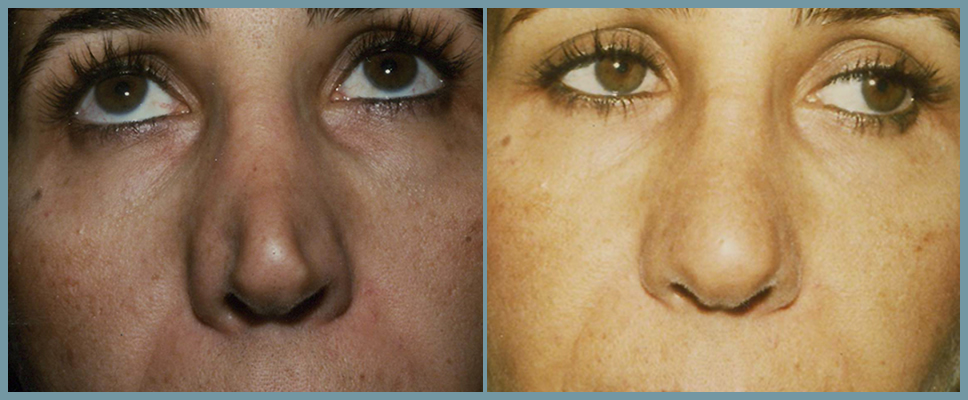 Nose Surgery - Rhinoplasty Women