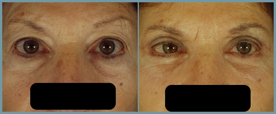 Eyelid Surgery - Blepharoplasty