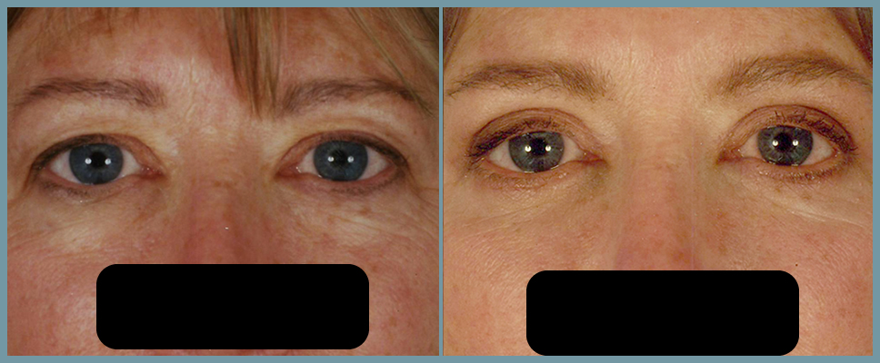 Eyelid Surgery - Blepharoplasty