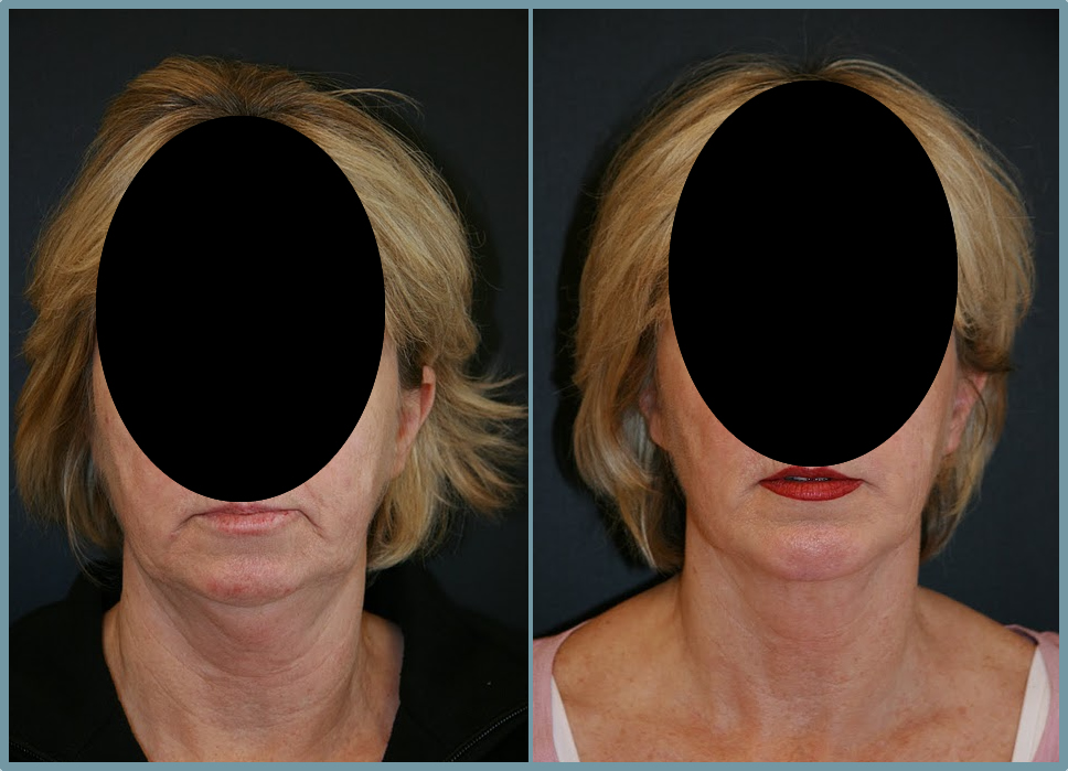 Chin Agumentation