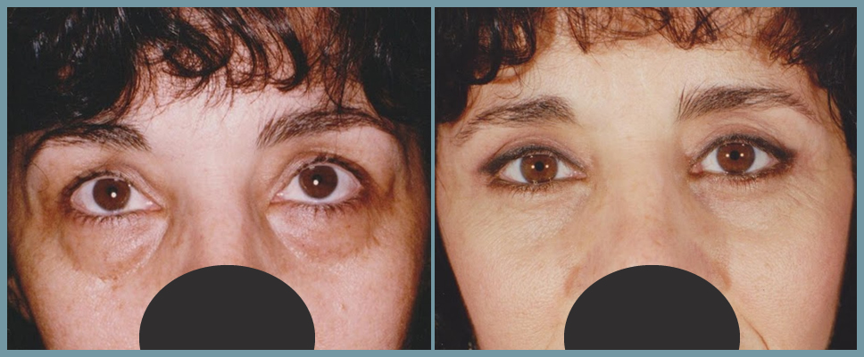 Eyelid Surgery - Blepharoplasty
