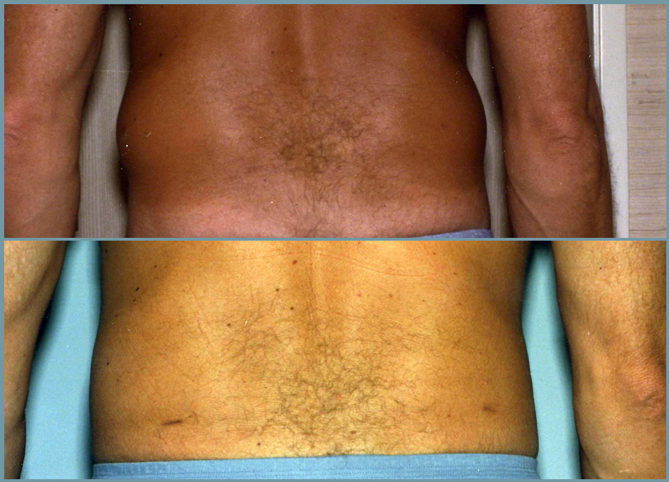 Abdominal Wall Liposuction Sculpture Male