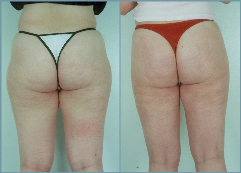 Liposculpturing of Hips