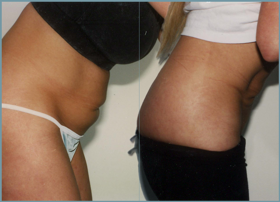 Liposculpturing