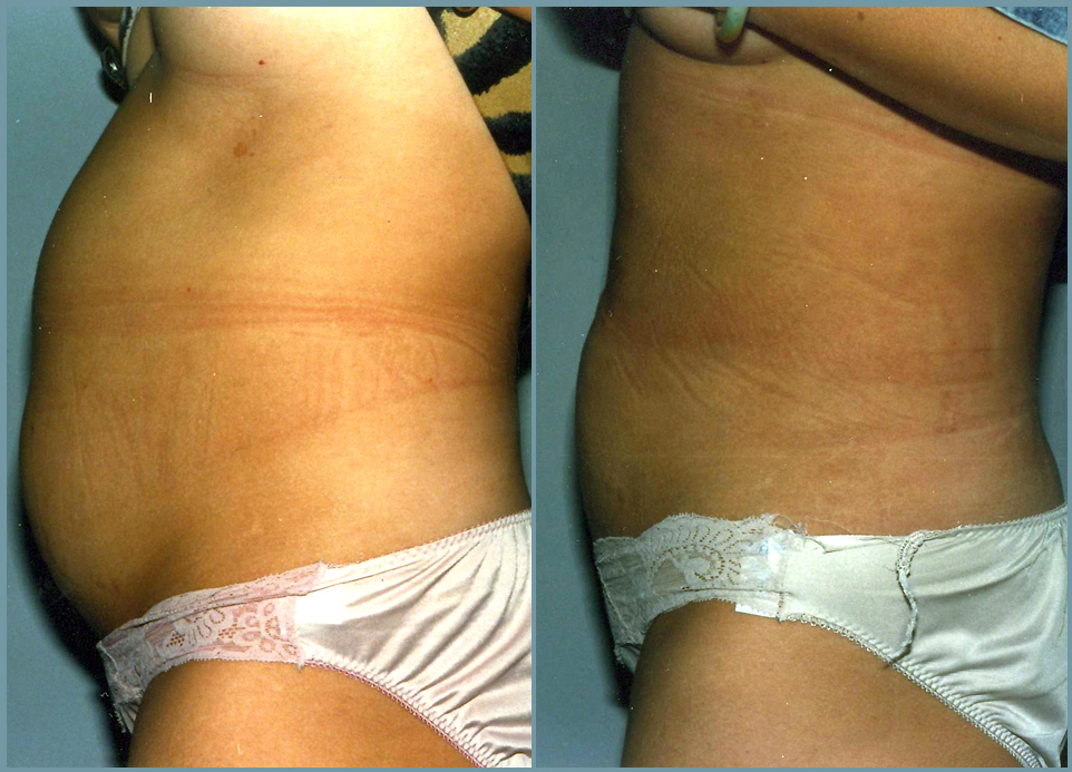 Liposculpturing