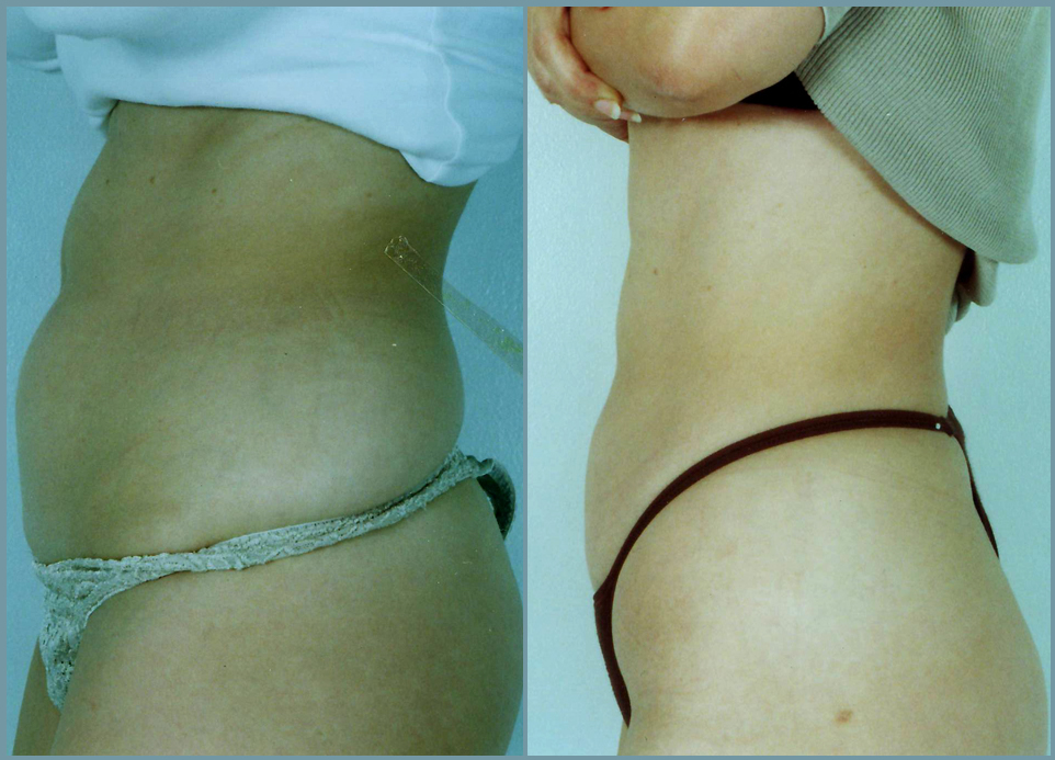 Liposculpturing