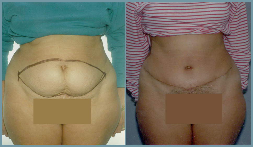 Abdomen - Abdominoplasty