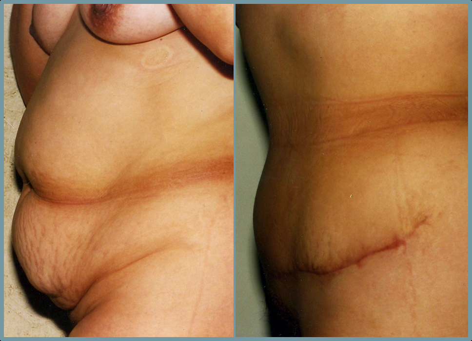 Abdomen - Abdominoplasty