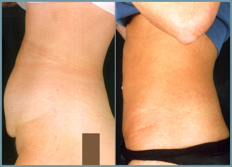 Abdominal Wall Reconstruction