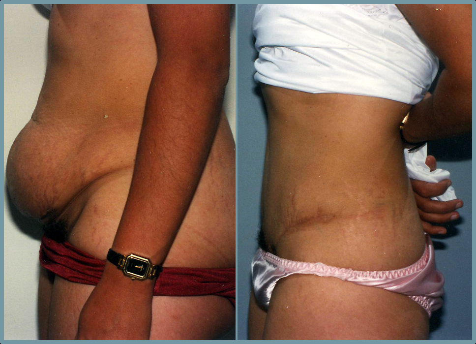 Abdomen - Abdominoplasty