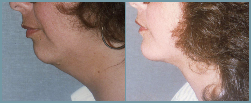Chin Agumentation