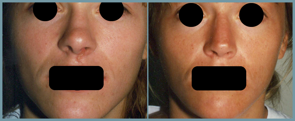 Nose Surgery - Rhinoplasty Women