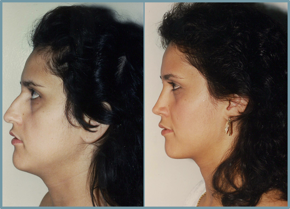 Nose Surgery - Rhinoplasty Women