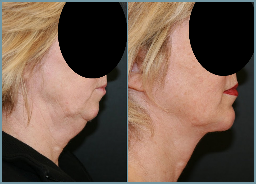 Chin Agumentation