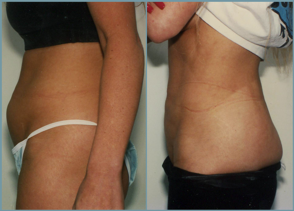 Abdominal Wall Liposuction Sculpture Female